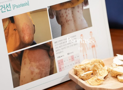 생기한의원으로 보는 건선 악화 요인과 생활 점검 항목